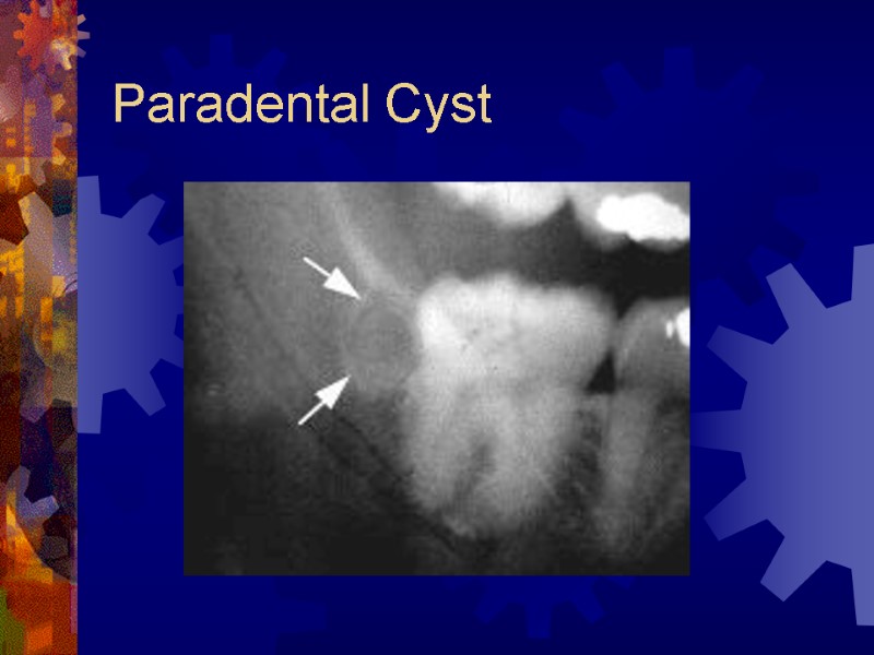 Paradental Cyst